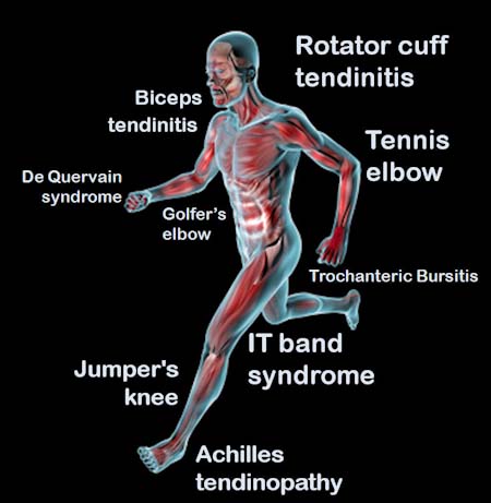 Tendonitis
