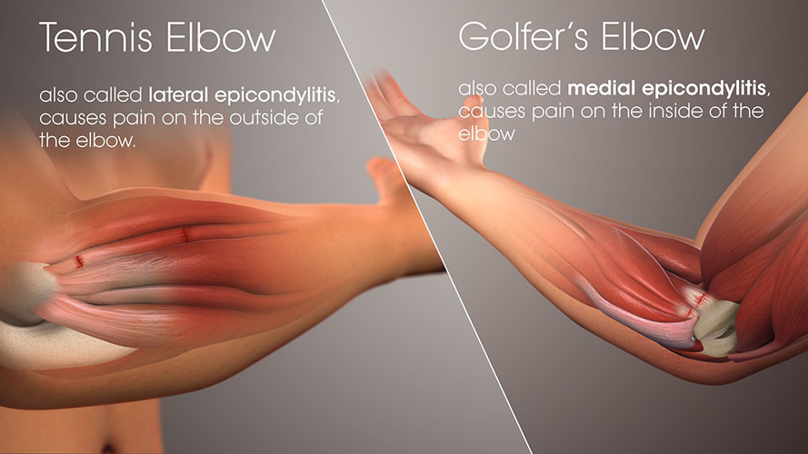 tennis elbow and golfers elbow